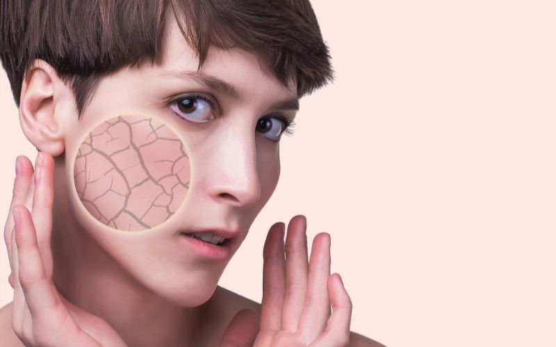 Dry skin